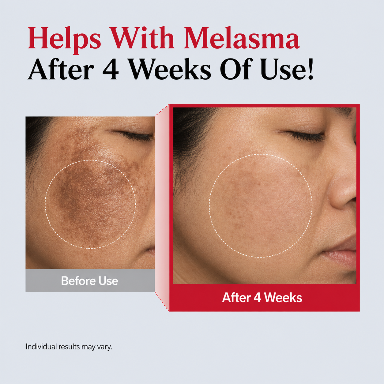 Melasma Recovery Serum
